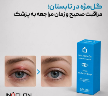 قرار دادن کمپرس گرم روی پلک مبتلا به گل‌مژه