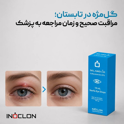قرار دادن کمپرس گرم روی پلک مبتلا به گلمژه