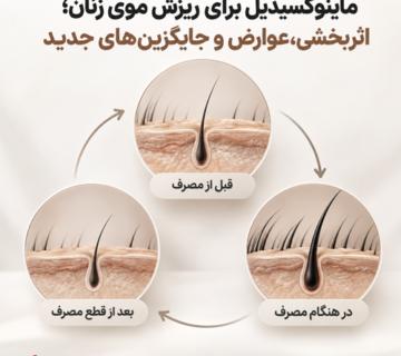 ماینوکسیدیل برای ریزش موی زنان