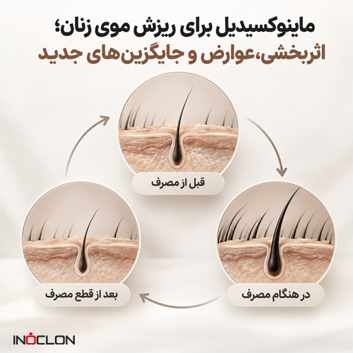 ماینوکسیدیل برای ریزش موی زنان