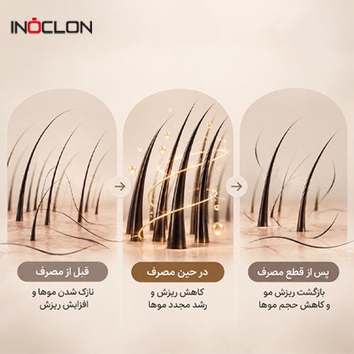 ماینوکسیدیل برای ریزش موی زنان